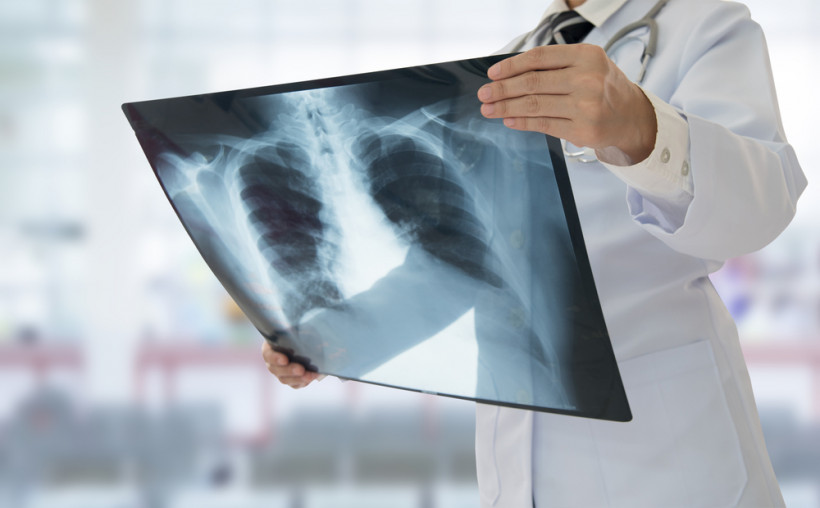 Пневмония - рентген-снимок в руках врача