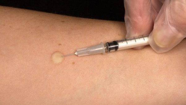 проба Манту