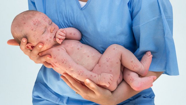 как проявляется и лечится краснуха, чем она опасна для беременных