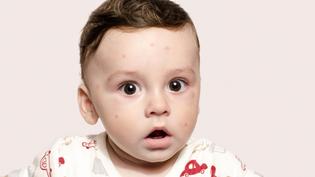 Коревая пневмония и другие опасные осложнения кори: узнаем, делаем выводы