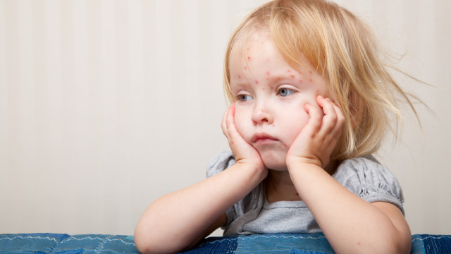 эпидемия кори в Украине