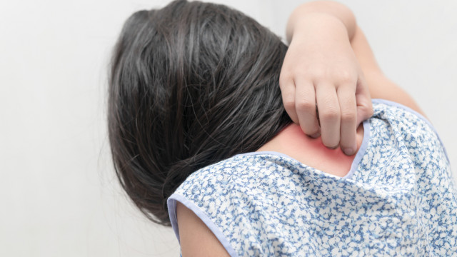 Псориаз у детей: почему при первых признаках нужно обратиться к врачу?