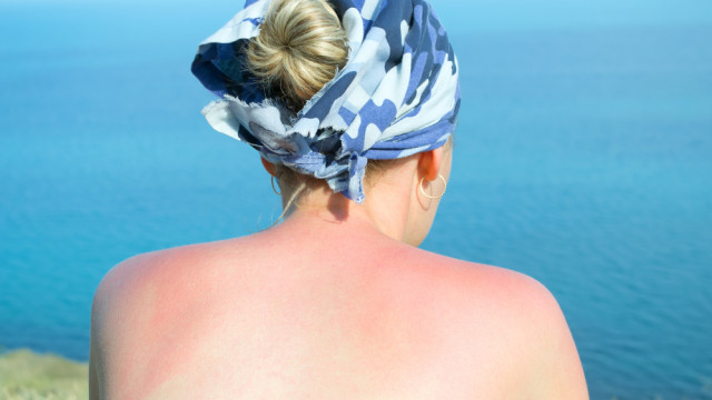 солнечные ожоги кожи